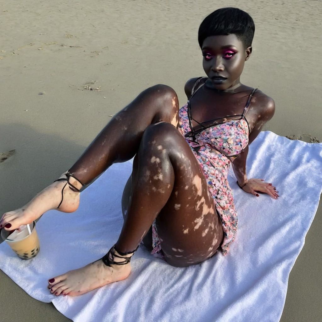 A woman with vitiligo is wearing a sweet summer strappy floral dress and is lying on a towel on the beach,  deep burgundy...